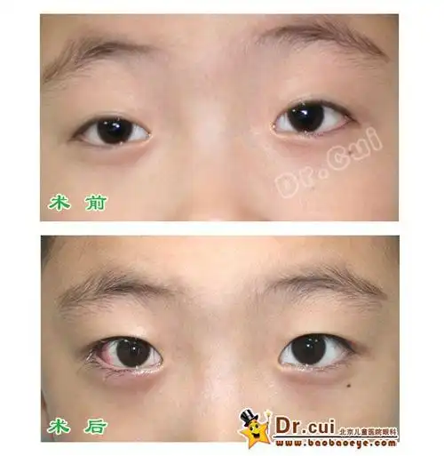 间歇性外斜视术前术后照片