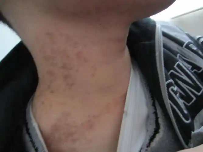 脖子上长了很多黑斑怎么办(有图)