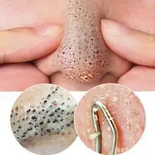 男士脸上毛孔堵塞如何是好?怎样疏通呢?