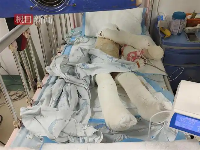 极目帮办|母女三人重度烧伤危在旦夕,父亲割皮救女恳求爱心人士伸援手