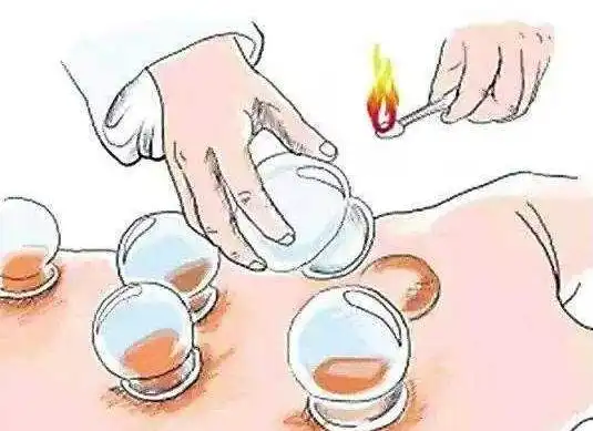 造成这样的事故可能是拔罐操作人员操作不慎或不当致酒精洒落烫伤,这