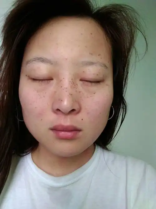 怎么去雀斑激光祛斑怎么样