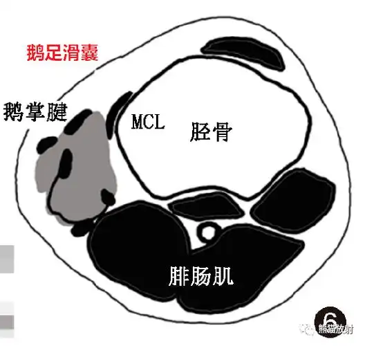 (图中彩色,灰色区域,红字为相应名称)膝外侧区滑囊