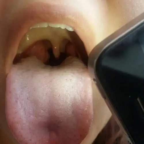 嗓子两侧的肉肉上有小眼,不知道是什么?舌头根部还有豆?