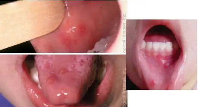 孩子发热伴口腔疱疹这个病到了感染高峰