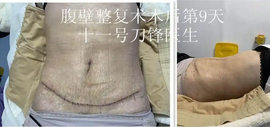 1_腹壁整形_腹壁整形治疗介绍 - 好大夫在线