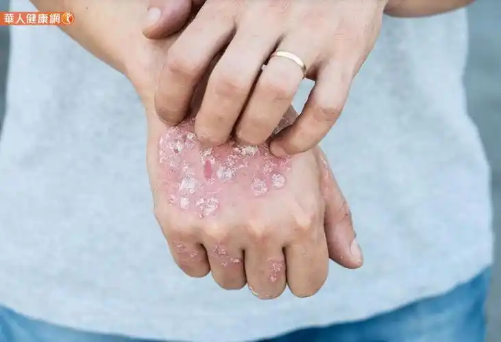 干癣治疗目标为3个手掌以下,临床医生建议中重度患者使用生物制剂.