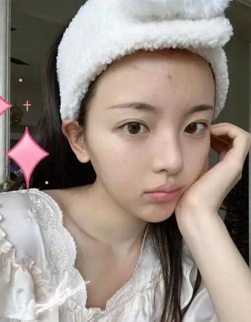 杨超越晒素颜照脸上痘痘脂肪粒明显配文我就当是一种风格了