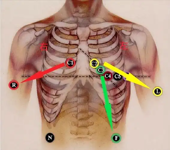 心电图各导联的正确位置(心电图导联位置图解)(2)