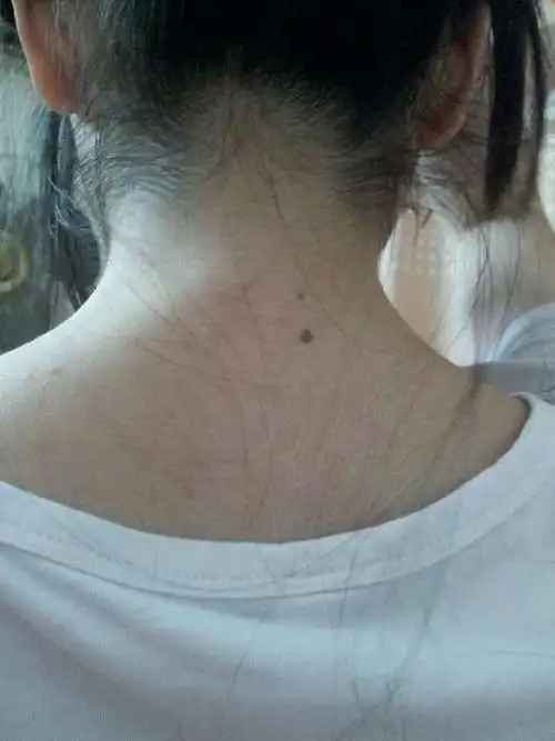 我(女)脖子后面有痣.这痣是好还是坏?