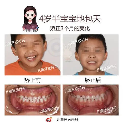 孩子地包天 · 千万别错过最佳矫正时间