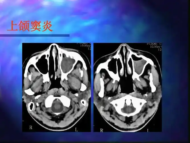 方便医学者 上颌窦炎