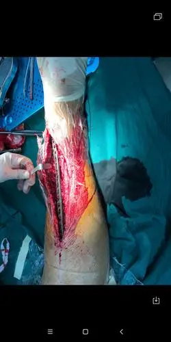 胫骨骨髓炎成功治疗!