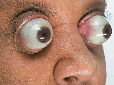 眼球最突出的人