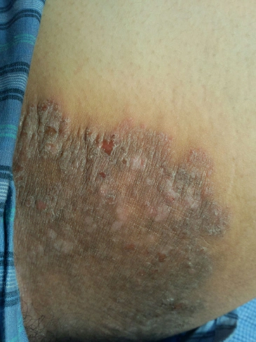 体癣图片_体癣症状表现图片大全_有来医生