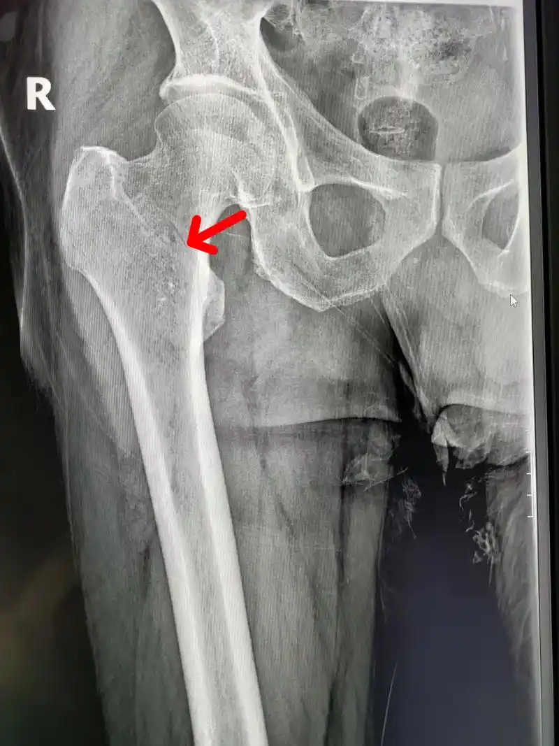 大清早的一外伤病人,男,67岁,因滑倒就诊,右股骨粗隆间骨折,就是我们