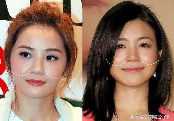 苹果肌下垂,法令纹加深,如何获得少女脸?