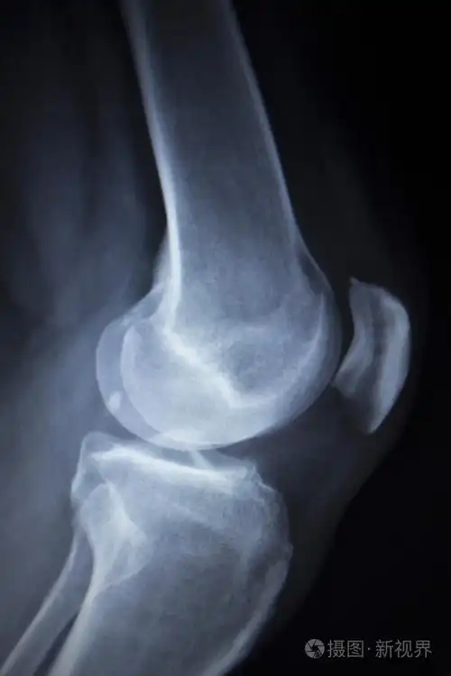 膝前痛腿半月板损伤的x线骨科扫描