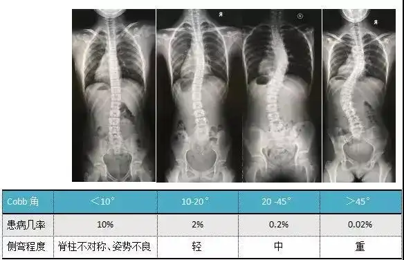 青少年脊柱侧弯
