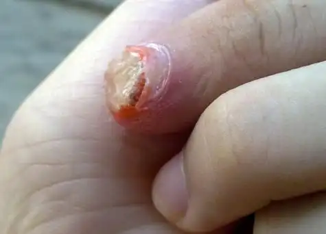 有图片.手指甲里面细菌感染,指甲完了.
