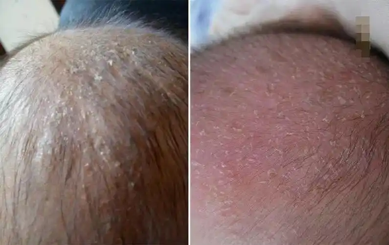 宝宝有头垢,千万别去抠!这样护理才正确