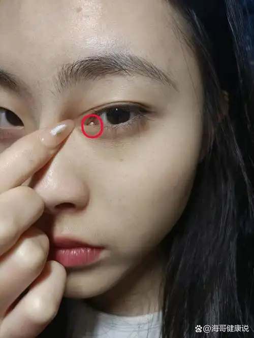 救命,眼角这个地方有个肉球,今天有点痛痛的,发现越