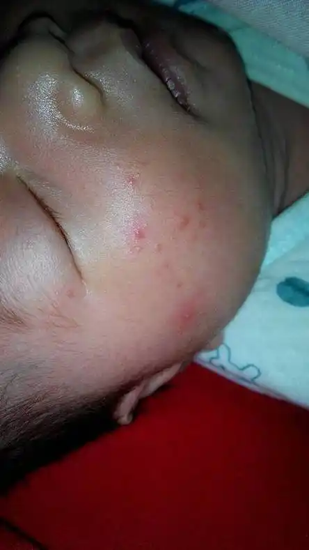 各位宝妈,帮忙看下,我家宝宝昨天开始脸上突然冒出很多红诊子,是怎么