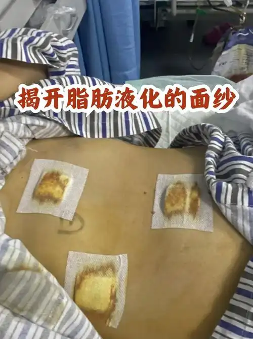 揭开脂肪液化的面纱