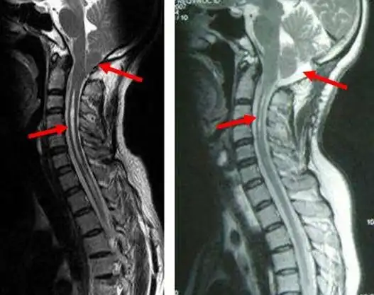 嵴髓空洞症(空洞形成,胶质增生)_财富号_东方财富网