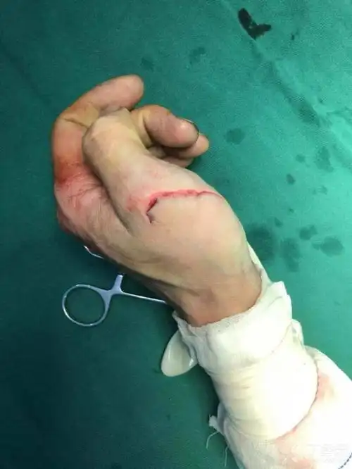 一侧血管神经是否需要吻合?