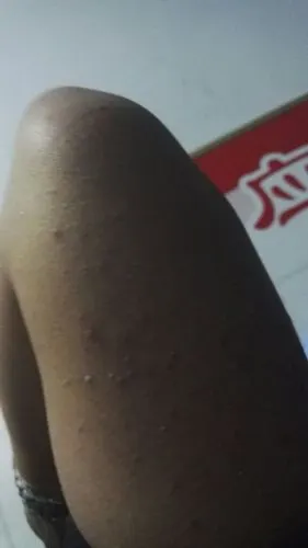 有一些红色的疙瘩,有的一挤有血出来.