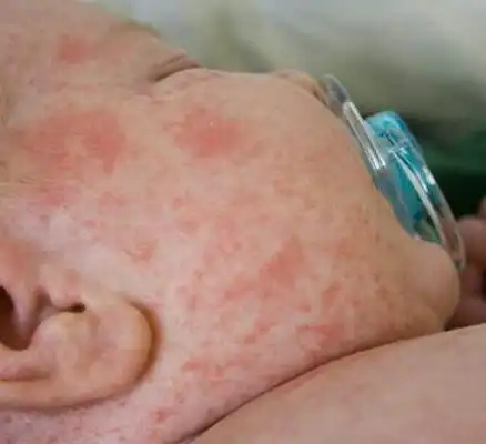 宝宝痱子图片47