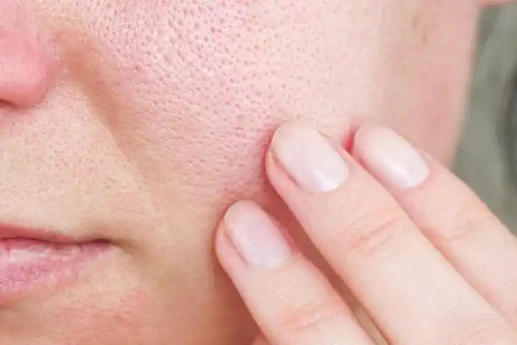 激光收缩毛孔前图片