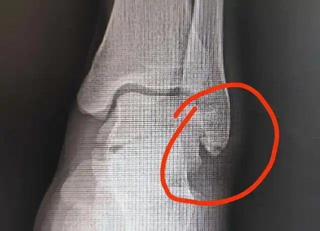 被自己的肌肉"撕"到骨折?年轻人要注意啊,不能太猛