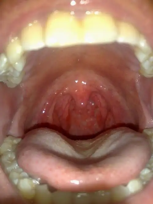 希望中医能给开服药 喉咙痛 很长时间了 声音也有点嘶哑 左边扁桃体