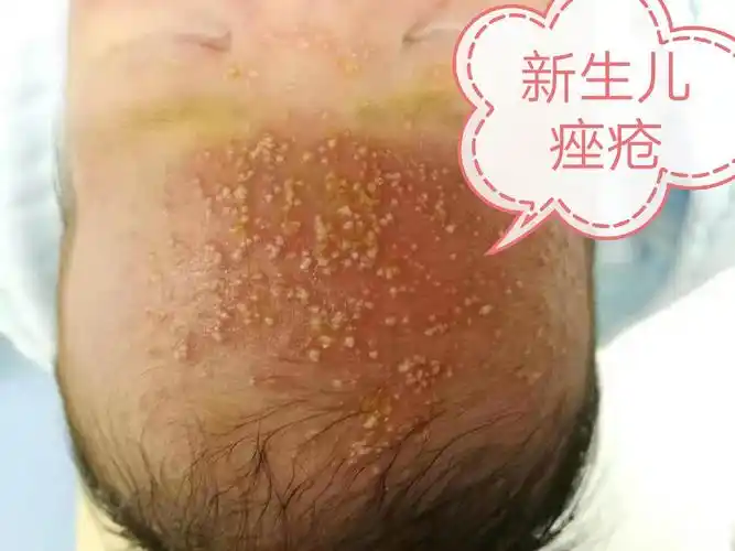 新生儿痤疮中医治疗病案一例