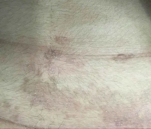 肚皮上一大片黑斑