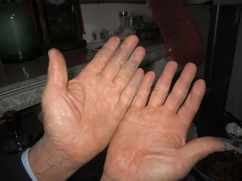 我爸爸是水泥匠,由于手长年弄水泥,手掌已被水泥侵蚀的很严重了,怎么