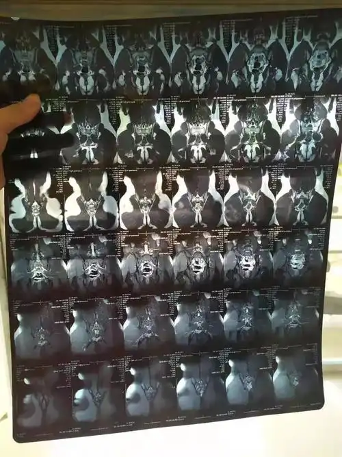 20岁体考生腰部受伤再也不能运动了吗不你能