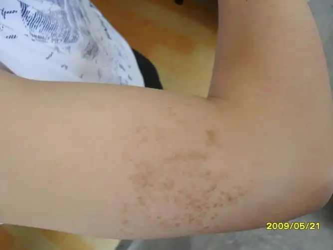 胳膊上的皮肤问题,斑斑点点的