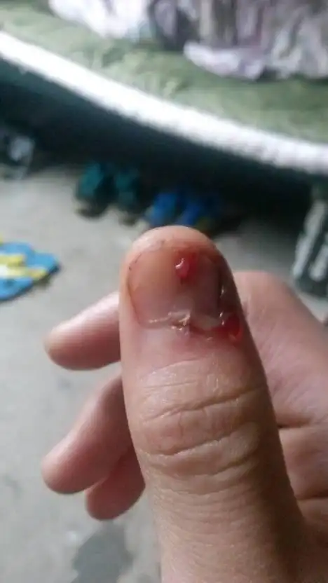 指甲因工作时被车床主轴绞伤导致半边指甲与手机分离,但因当时流血过