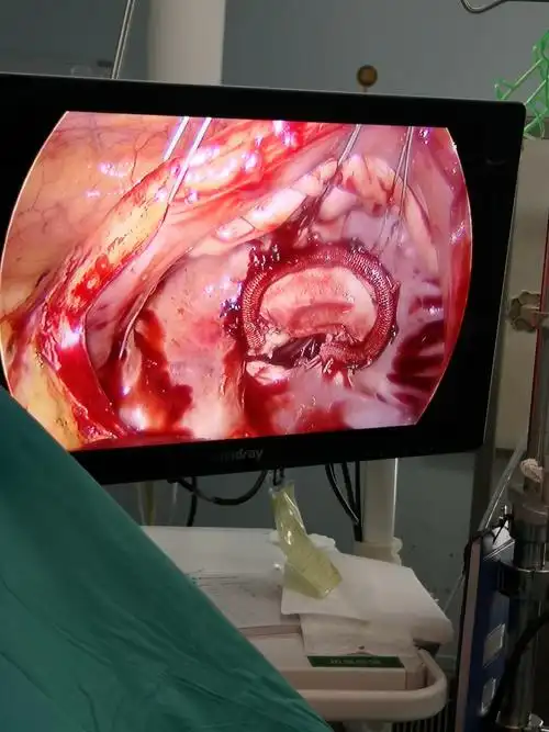 心脏手术再创新高——胸腔镜下二次三尖瓣成形术获得成功