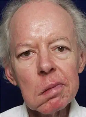 九针综合治疗机对面神经麻痹的治疗方案面神经麻痹又称面瘫,俗称歪嘴