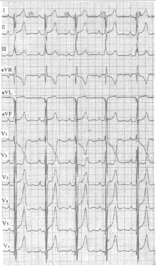 右房扩大-12导联心电图同步诊断学-医学