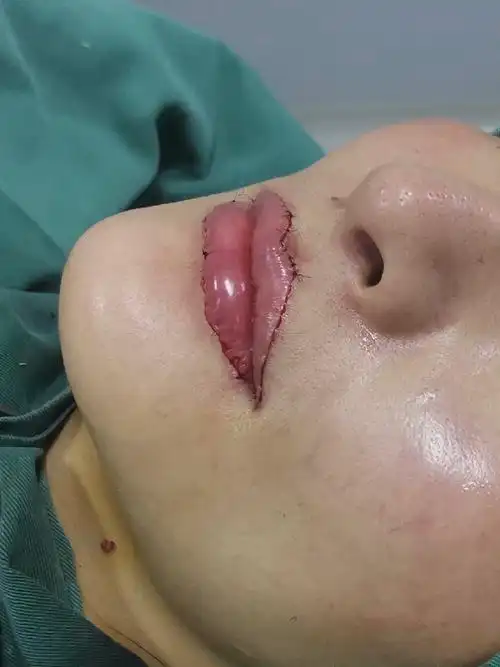 早就想做薄唇增厚了但是感觉新氧上面做这个手术的医院不是很多还挺