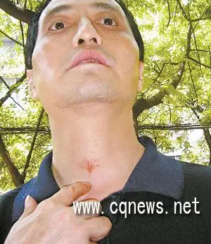 无辜受害者聂某所受枪伤还清晰可见.