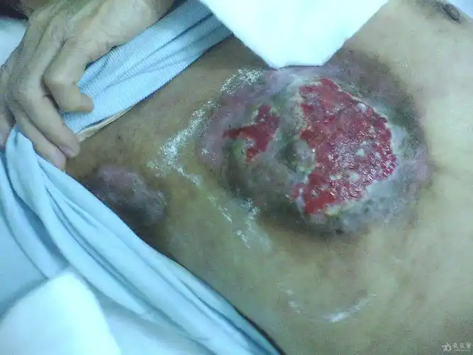 乳腺癌出现这情况请教下各位有没好的办法