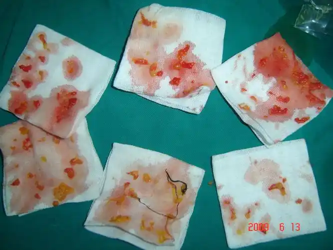 汗腺我做的微创手术,术后即可效果注射肉毒素治疗腋臭注射肉毒素治疗