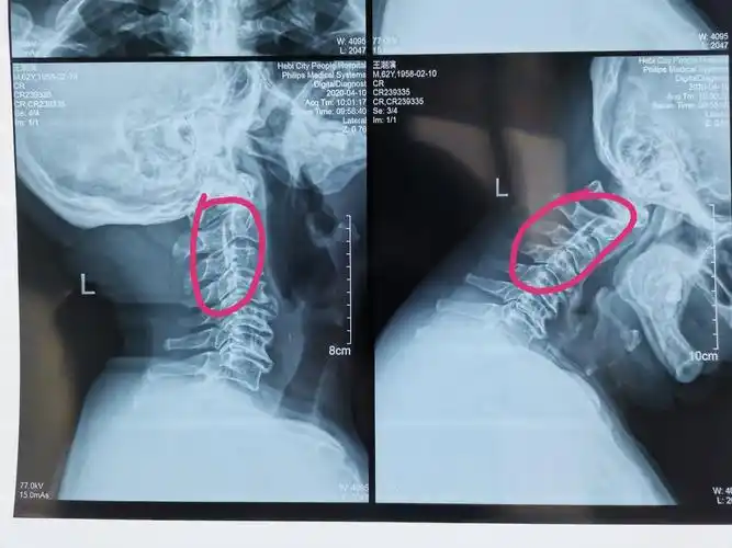 颈椎病专题(一) : 复杂颈椎病病例分享
