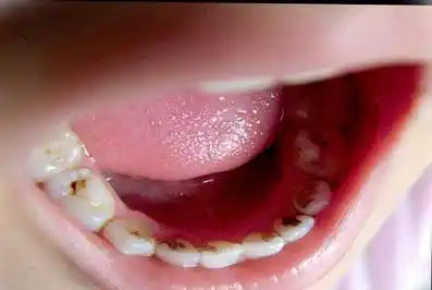 孩子牙齿发黑怎么办?